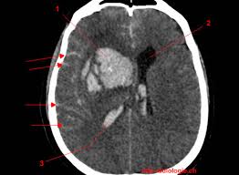 hemorragie capsulo lenticulaire